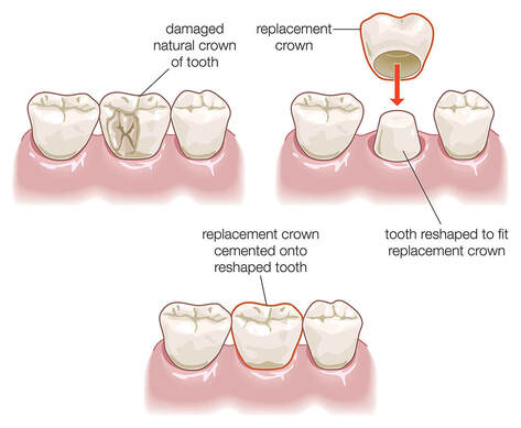 How a dental implant is placed - Step by step pictorial.