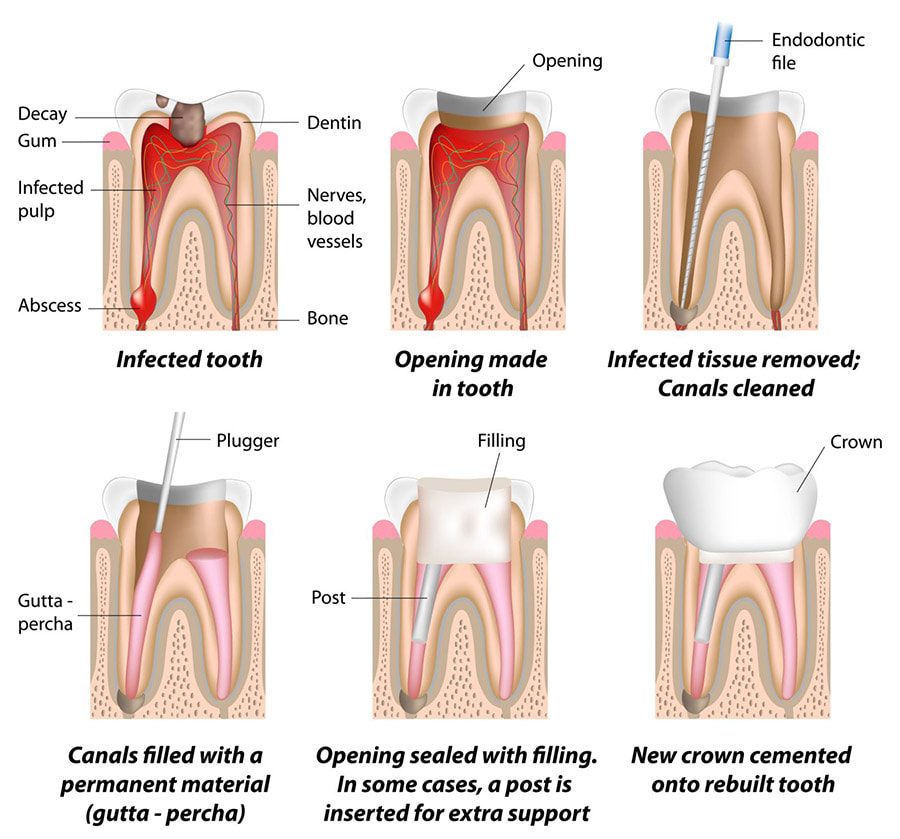 How a root canal procedure is done - Step by step pictorial.